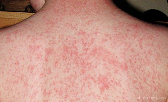 Measles Eliminated For First Time In Uk