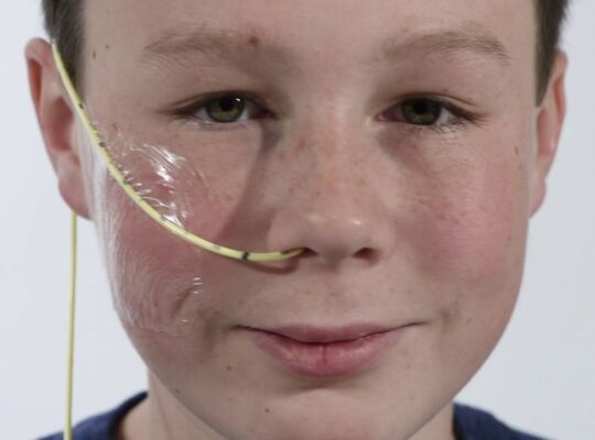 Feeding Tubes Were Mistakenly Inserted Into Patients Lungs For Six Month Period