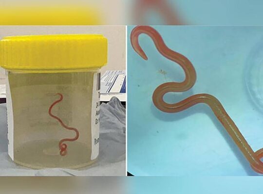 World’s First Discovery Of  Worm In Brain Of Woman From New South  Wales