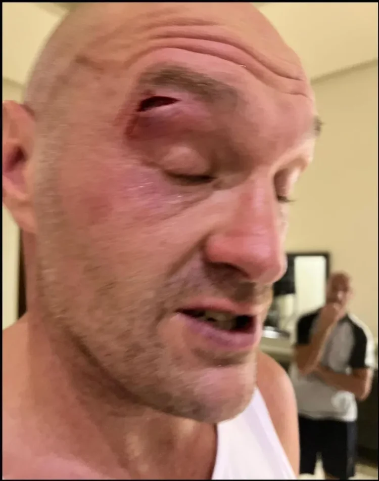 Tyson Fury’s Heavyweight Bout With Usyk Postponed Over