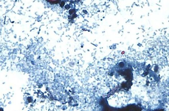 Parasite Outbreak Surges Past 1,000 Cases