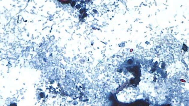 Parasite Outbreak Surges Past 1,000 Cases